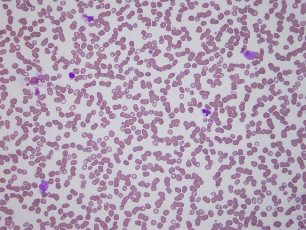 Rare blasts in peripheral blood